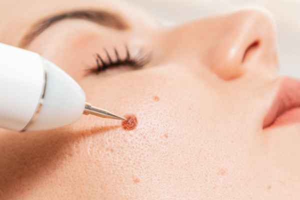 CryoPen: 5 Skin Concerns It May Be Used to Treat 3 What actually happens during a CryoPen treatment Melton Mowbray?