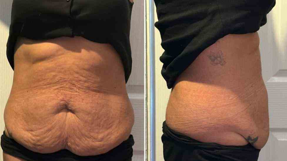 Lost the Weight but Not the Loose Skin? What You Should Know 1 Is It Definitely Loose Skin Melton Mowbray?
